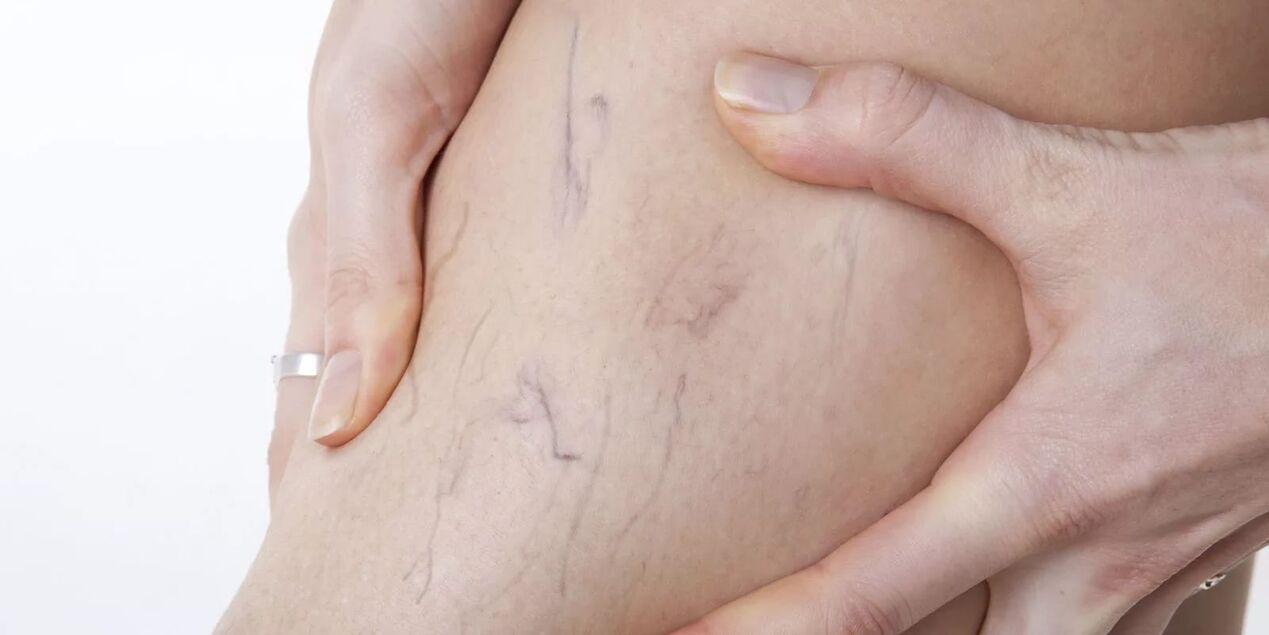 Vor der Verwendung von Varicons -Creme