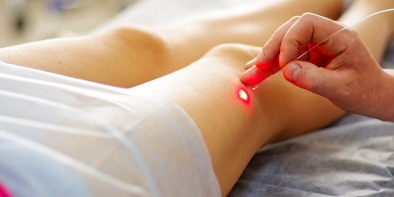 Das endovenöse Laser-Venenkoagulationsverfahren bei Krampfadern.